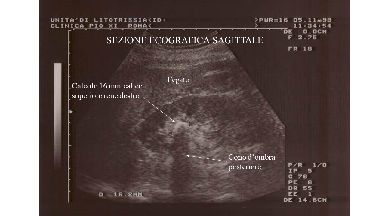 Ectasia Calico Pielica Rene Dx