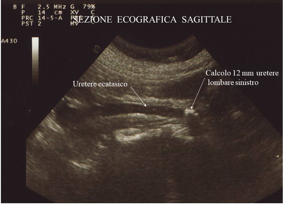Ectasia Calico Pielica Rene Dx