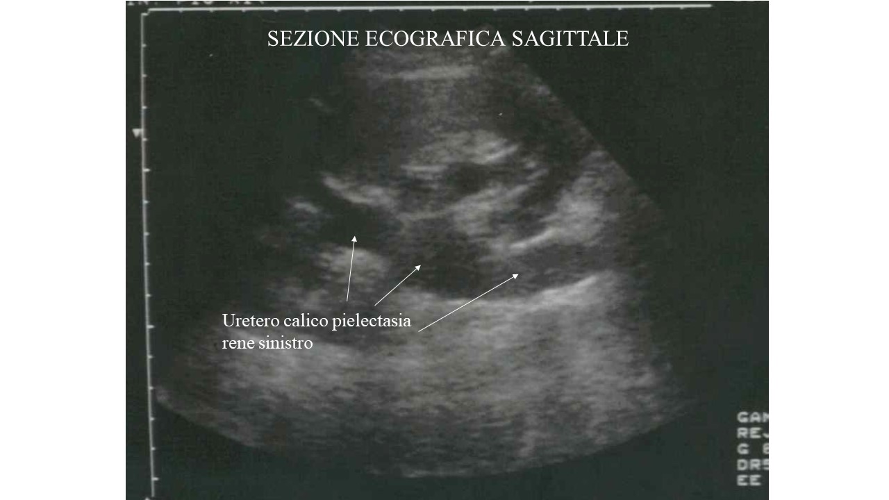 Ectasia Calico Pielica Rene Dx