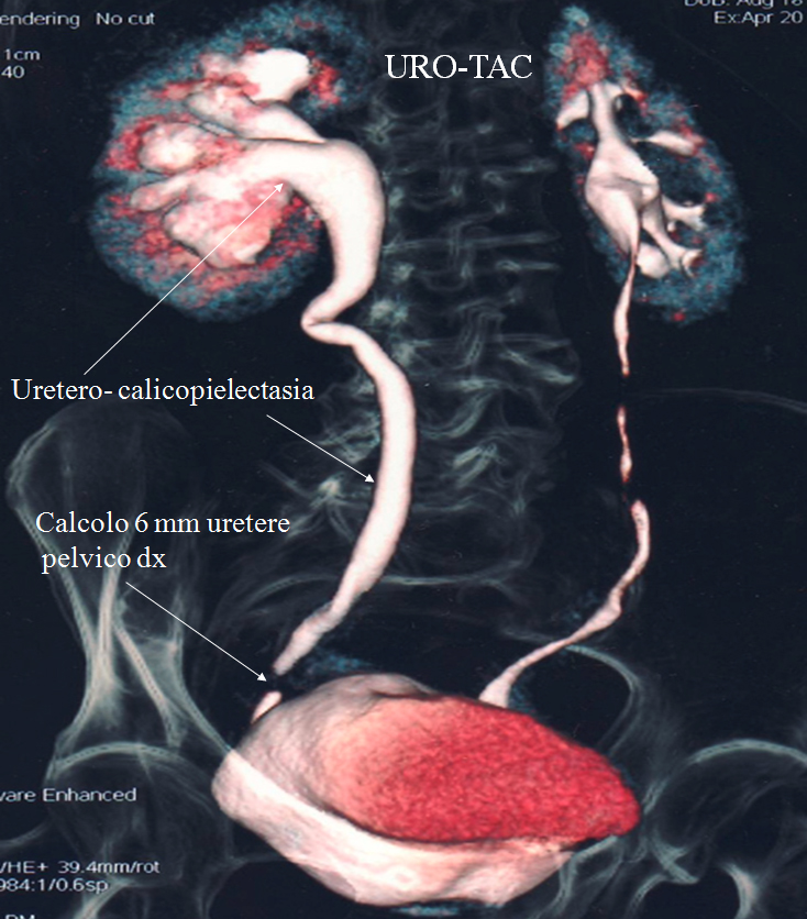 Calcolo Uretere Pelvico Destro Unit Di Litotrissia Extracorporea Roma calcolo-uretere-pelvico-destro-unit-di-litotrissia-extracorporea-roma