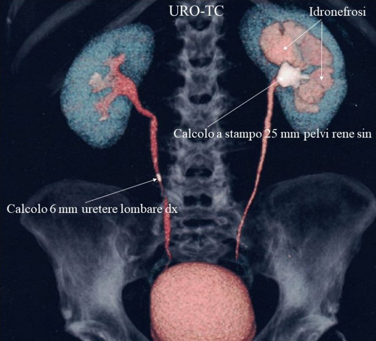 Indagini per sospetto litiasi delle vie urinarie calcoli vie urinarie litotrissia Indagini per sospetto litiasi delle vie urinarie calcoli vie urinarie litotrissia