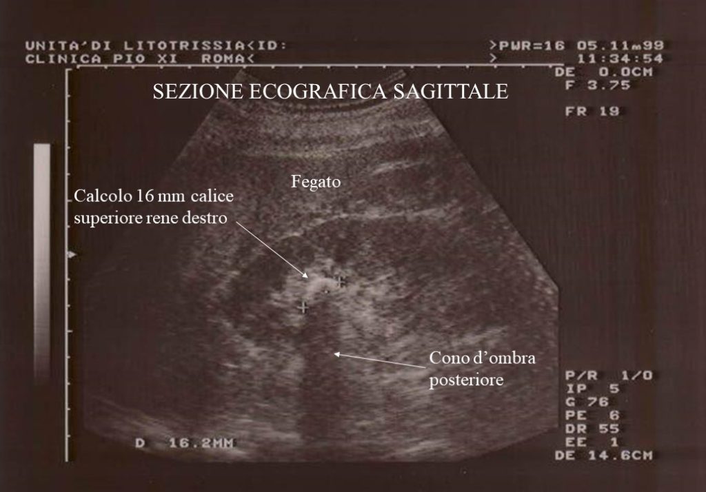 Ectasia Calico Pielica Rene Dx