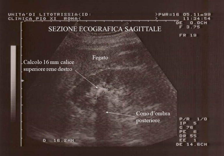 Ectasia Calico Pielica Rene Dx