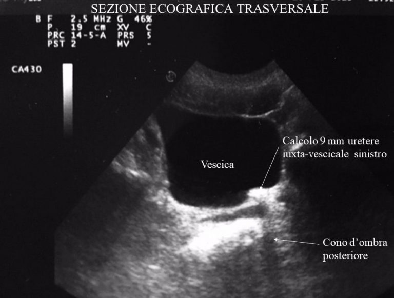 Ectasia Calico Pielica Rene Dx