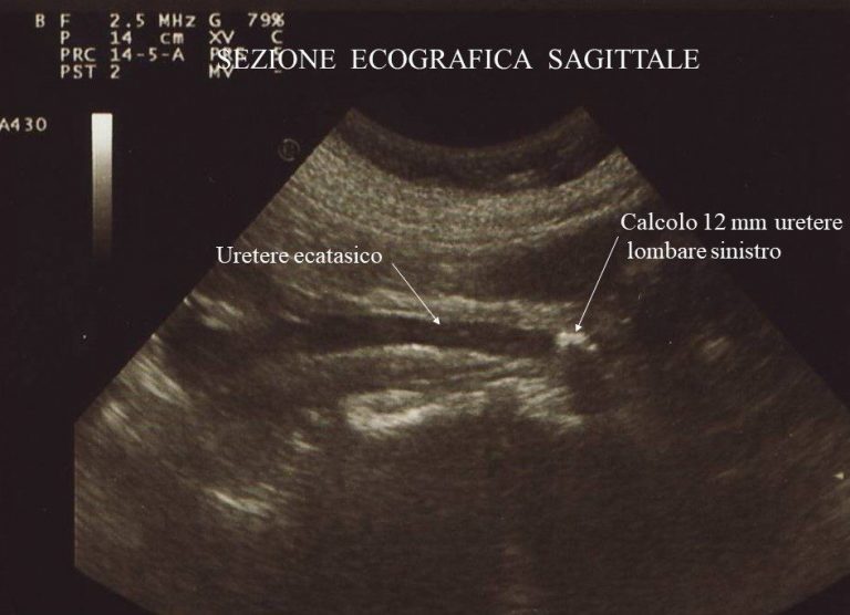 Ectasia Calico Pielica Rene Dx