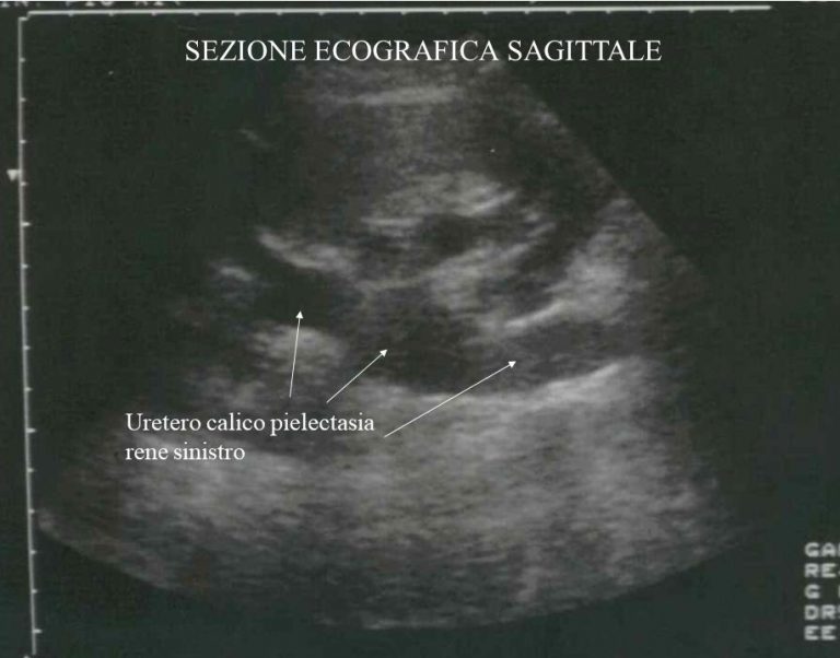 Ectasia Calico Pielica Rene Dx