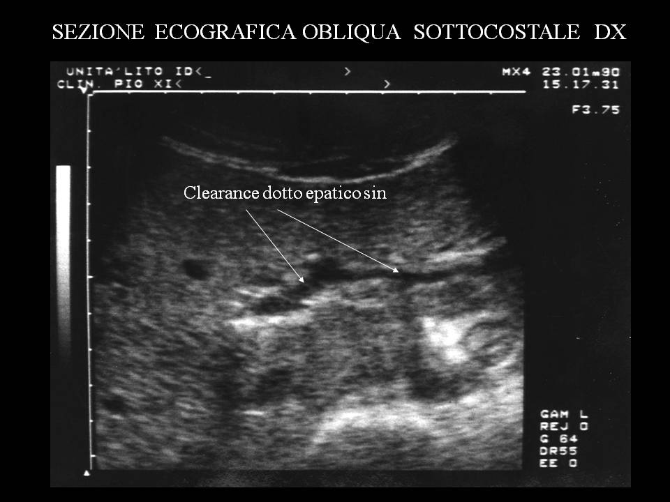 Litiasi multipla delle vie biliari intraepatiche ECO 10gg PostLito Unità di litotrissia Litiasi multipla delle vie biliari intraepatiche ECO 10gg PostLito Unità di litotrissia